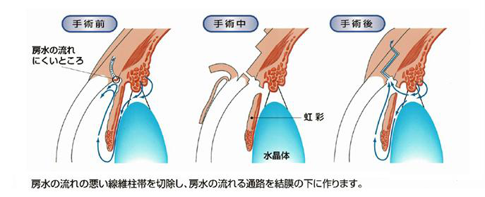 動画でわかる緑内障手術 緑内障手術 | 溝の口あそう眼科