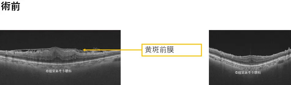 硝子体手術 | 溝の口あそう眼科